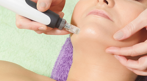 microneedling