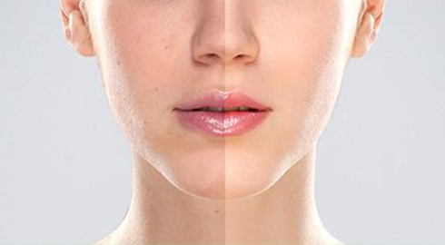 skin rejuvenation